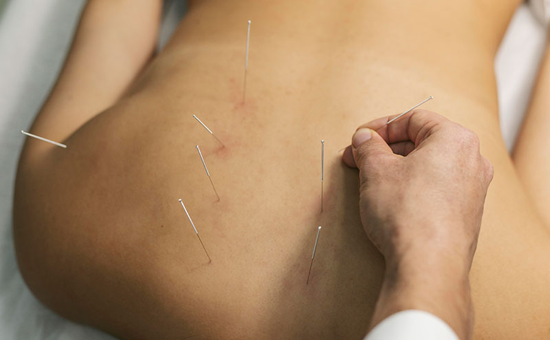 Dry needling